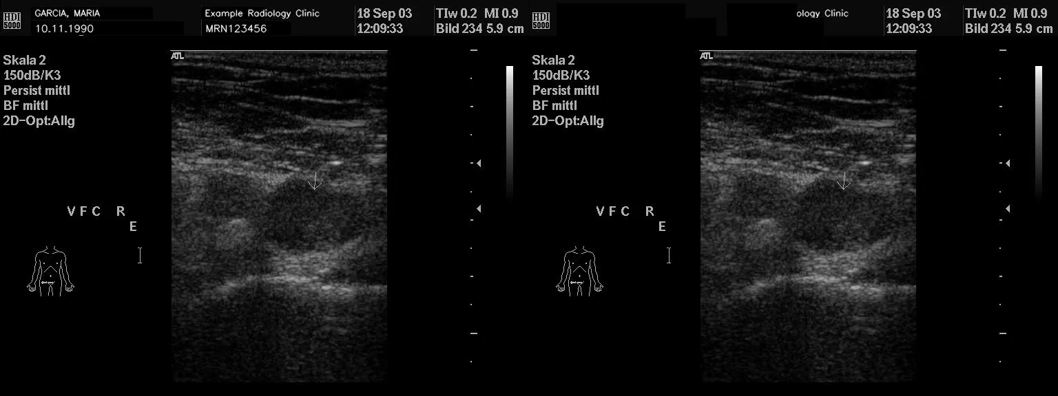 Before-and-after ultrasound frame. Left: a grayscale ATL HDI 5000 ultrasound whose top-left banner carries burned-in patient identifiers (name, DOB, clinic, MRN). Right: the same frame after Florence-2 anonymization, with the identifier region replaced by a solid black box and the diagnostic image intact.