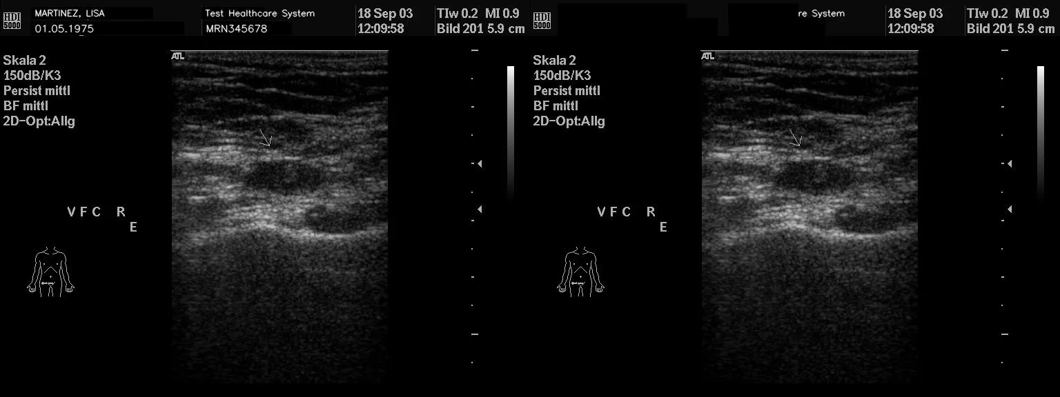 A second grayscale B-mode ultrasound shown before and after, identifiers redacted.