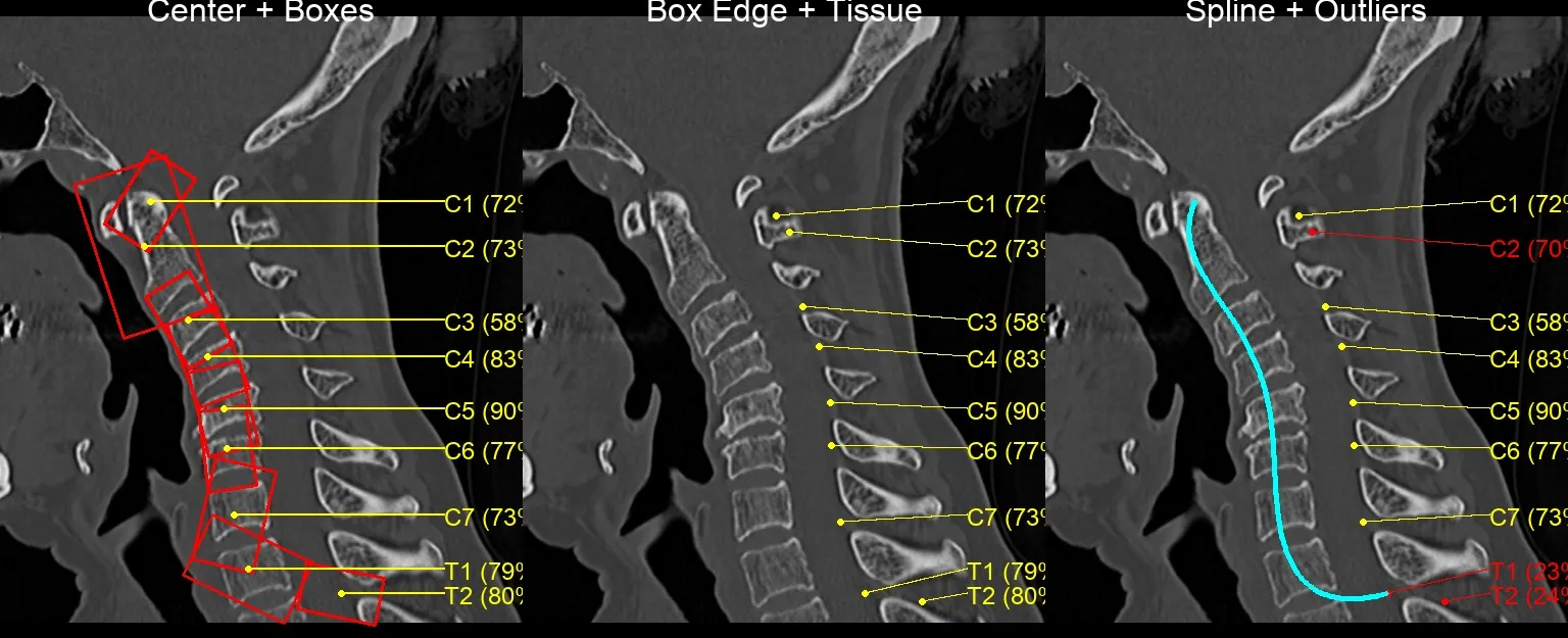 Sagittal cervical-spine CT in three panels; the spline QA flags C2 and T1/T2 in red as low-confidence outliers.