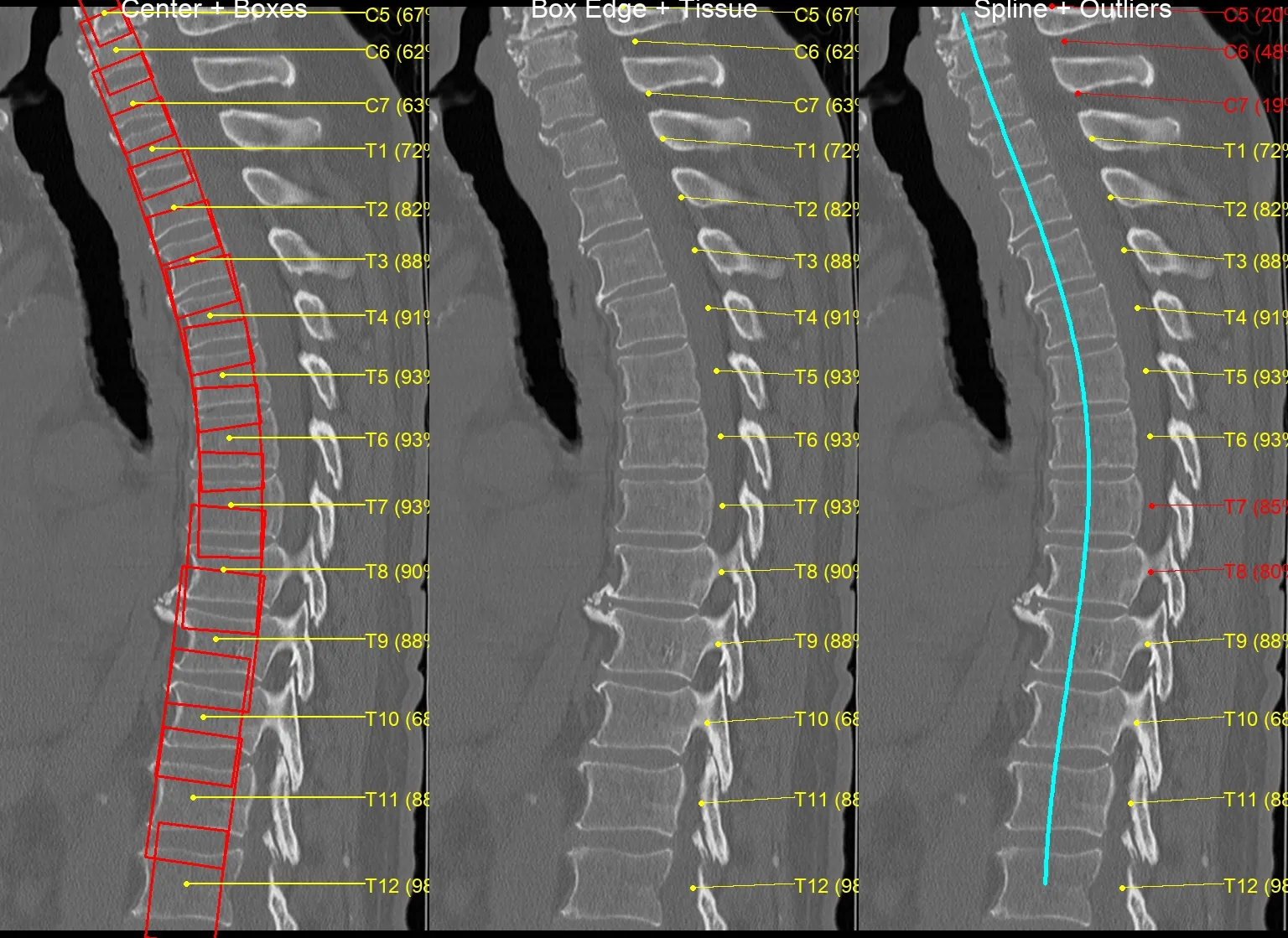 Sagittal CT of the thoracic spine in three panels: red per-vertebra bounding boxes labeled C5–T12, the same scan reduced to yellow center points, and a cyan spline through the vertebral centers with the top levels flagged red as geometric outliers.