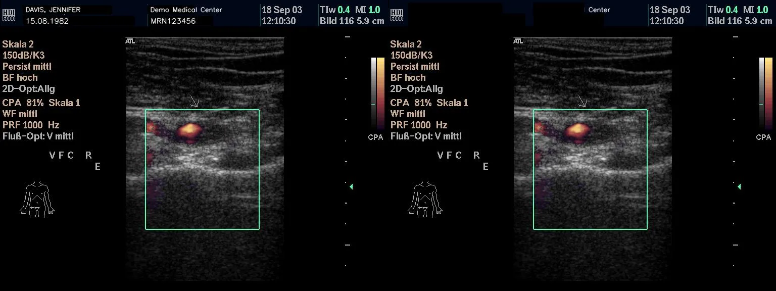 Before/after color power-Doppler ultrasound; the identifier banner is redacted while the color-flow overlay and green ROI box are preserved.