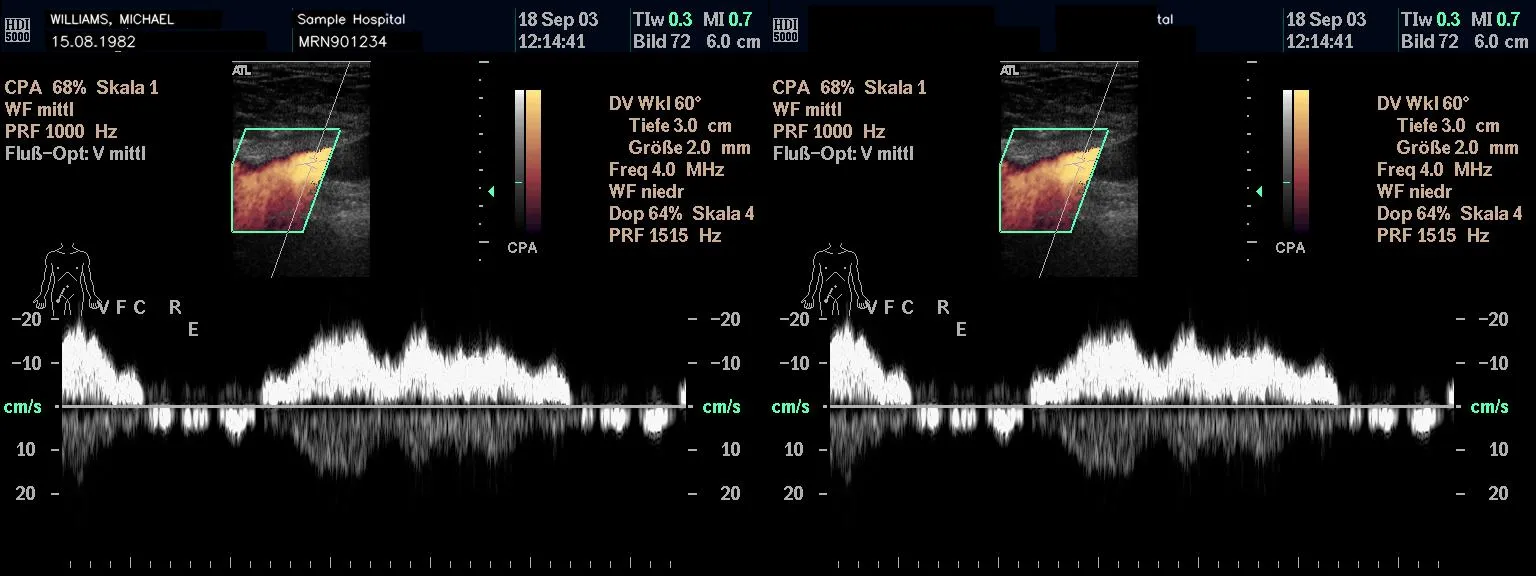Before/after spectral-Doppler study with a velocity waveform and color inset; identifiers redacted, the diagnostic trace preserved.